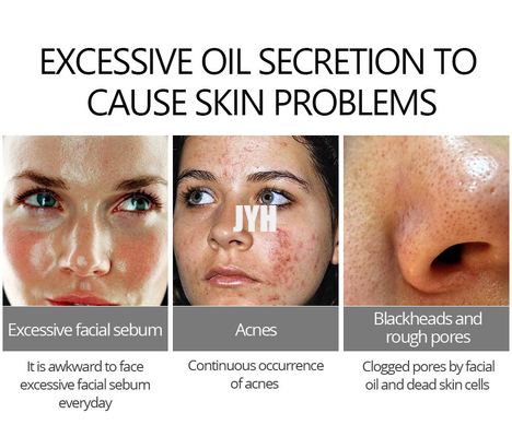 De zachte van de de Acnebehandeling van de Huidzorg Room 30g voor Acne Naar voren gebogen Gevoelige Huid